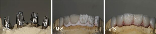 Fred — Implant Abutments