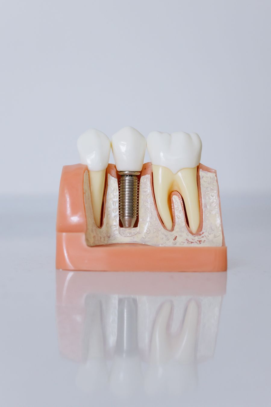 Existing Fillings, Crowns & Dental Work